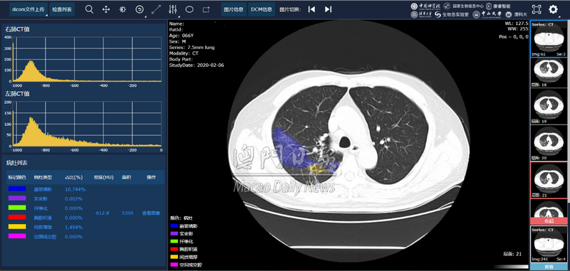 CT影像的病灶識別和定量分析.png